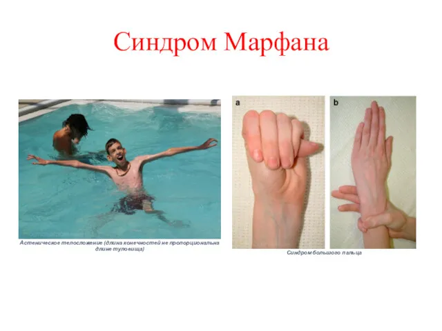 Синдром Марфана