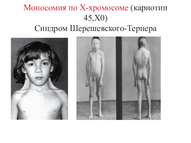 Моносомия по X-хромосоме (кариотип 45,X0) Синдром Шерешевского-Тернера