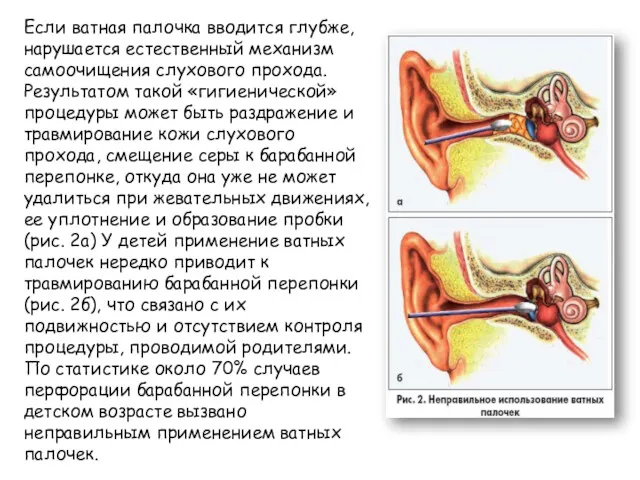 Если ватная палочка вводится глубже, нарушается естественный механизм самоочищения слухового