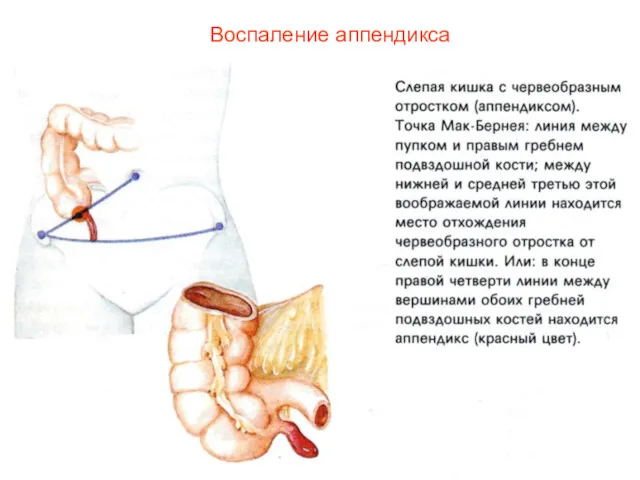 Воспаление аппендикса