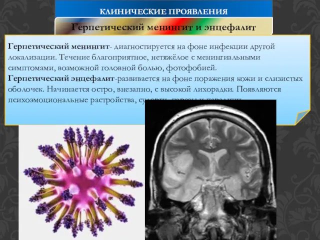 КЛИНИЧЕСКИЕ ПРОЯВЛЕНИЯ Герпетический менингит и энцефалит Герпетический менингит- диагностируется на