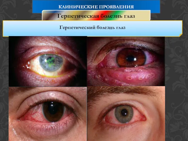 КЛИНИЧЕСКИЕ ПРОЯВЛЕНИЯ Герпетическая болезнь глаз Герпетический болезнь глаз