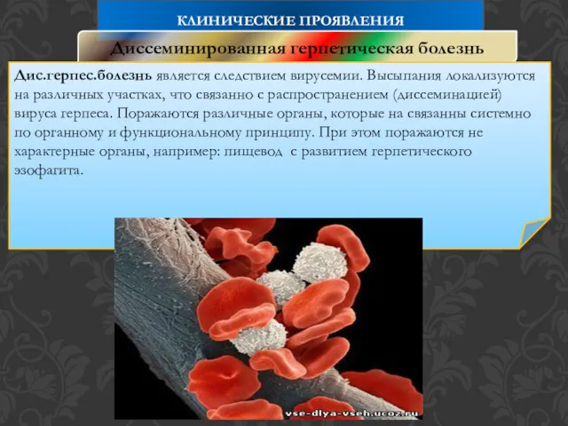 КЛИНИЧЕСКИЕ ПРОЯВЛЕНИЯ Диссеминированная герпетическая болезнь Дис.герпес.болезнь является следствием вирусемии. Высыпания