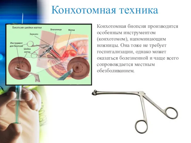 Конхотомная техника Конхотомная биопсия производится особенным инструментом (конхотомом), напоминающим ножницы.