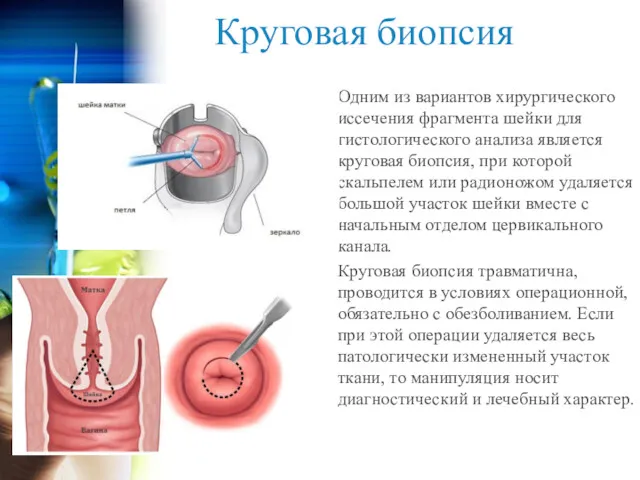 Круговая биопсия Одним из вариантов хирургического иссечения фрагмента шейки для гистологического анализа является