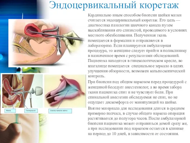 Эндоцервикальный кюретаж Кардинально иным способом биопсии шейки матки считается эндоцервикальный кюретаж. Его цель