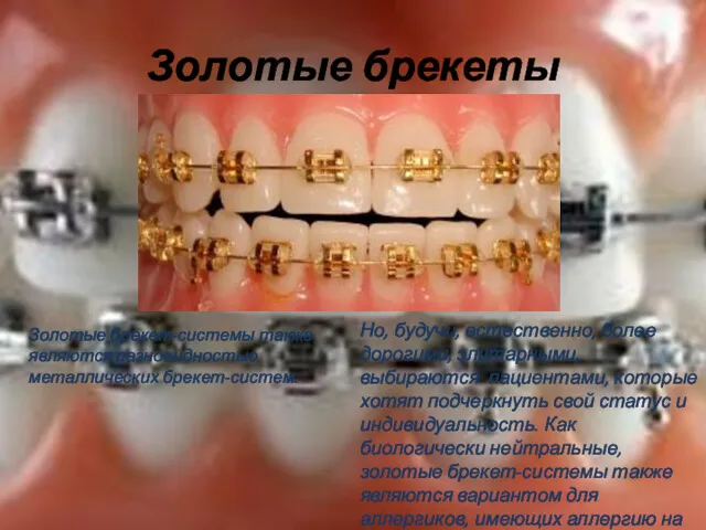 Золотые брекеты Золотые брекет-системы также являются разновидностью металлических брекет-систем. Но, будучи, естественно, более