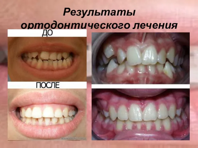 Результаты ортодонтического лечения