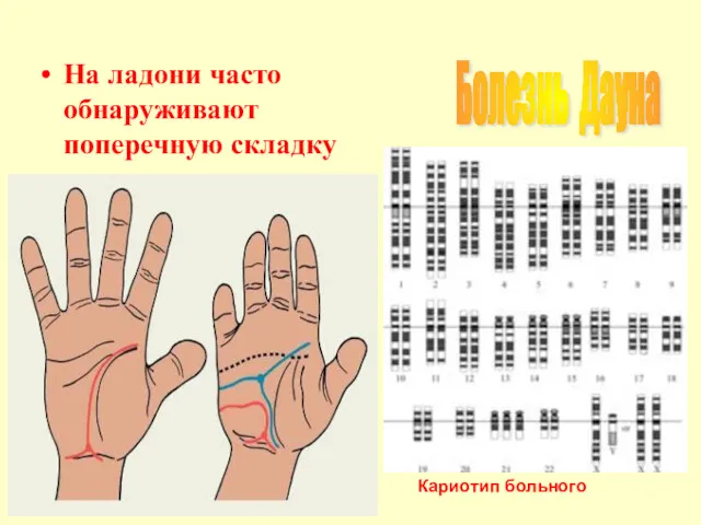 На ладони часто обнаруживают поперечную складку Болезнь Дауна Кариотип больного