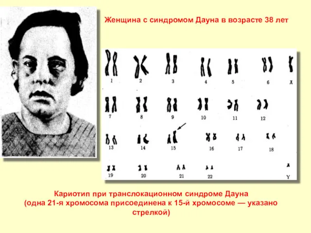 Кариотип при транслокационном синдроме Дауна (одна 21-я хромосома присоединена к