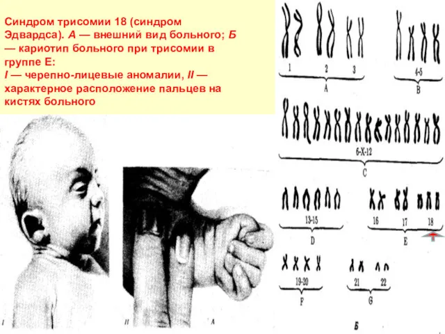 Синдром трисомии 18 (синдром Эдвардса). А — внешний вид больного;