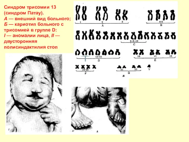 Синдром трисомии 13 (синдром Патау). А — внешний вид больного;