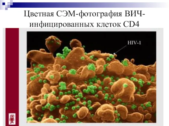 Цветная СЭМ-фотография ВИЧ-инфицированных клеток CD4