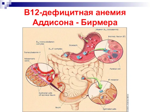 В12-дефицитная анемия Аддисона - Бирмера