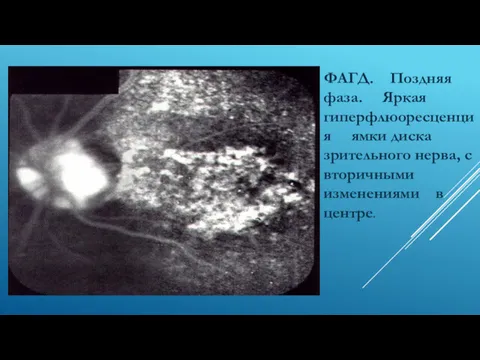 ФАГД. Поздняя фаза. Яркая гиперфлюоресценция ямки диска зрительного нерва, с вторичными изменениями в центре.