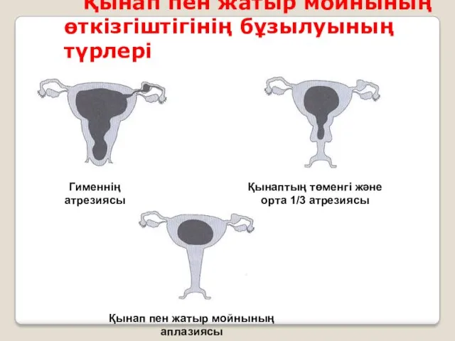 Қынап пен жатыр мойнының өткізгіштігінің бұзылуының түрлері Гименнің атрезиясы Қынап