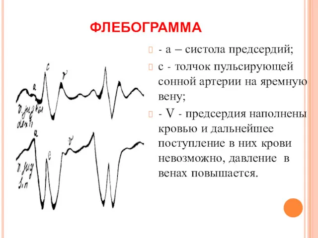 ФЛЕБОГРАММА - а – систола предсердий; с - толчок пульсирующей