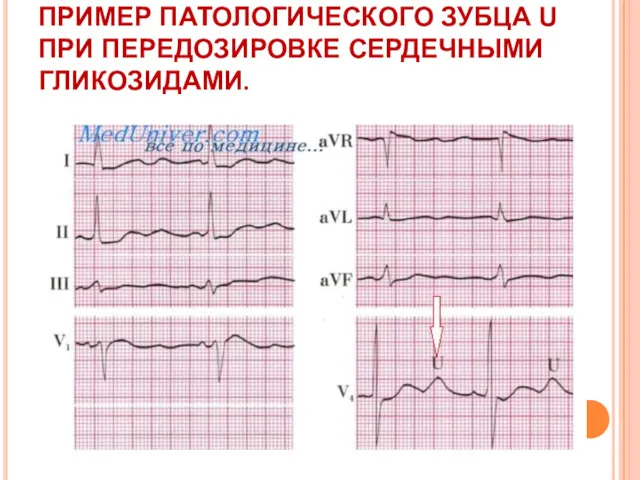 ПРИМЕР ПАТОЛОГИЧЕСКОГО ЗУБЦА U ПРИ ПЕРЕДОЗИРОВКЕ СЕРДЕЧНЫМИ ГЛИКОЗИДАМИ.