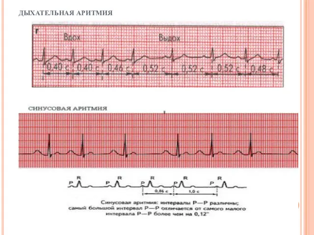 ДЫХАТЕЛЬНАЯ АРИТМИЯ