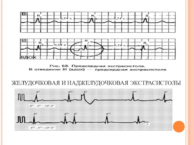ЖЕЛУДОЧКОВАЯ И НАДЖЕЛУДОЧКОВАЯ ЭКСТРАСИСТОЛЫ