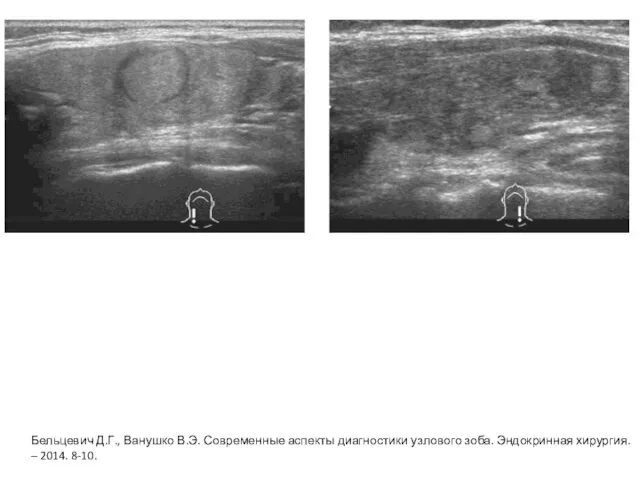 Бельцевич Д.Г., Ванушко В.Э. Современные аспекты диагностики узлового зоба. Эндокринная хирургия. – 2014. 8-10.