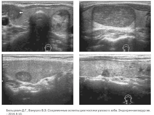Бельцевич Д.Г., Ванушко В.Э. Современные аспекты диагностики узлового зоба. Эндокринная хирургия. – 2014. 8-10.