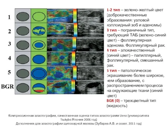 1-2 тип – зелено-желтый цвет (доброкачественные образования: узловой коллоидный зоб