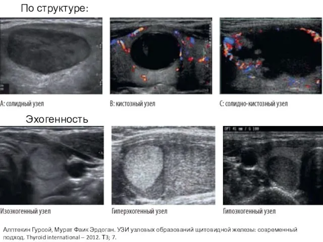 По структуре: Эхогенность Алптекин Гурсой, Мурат Фаик Эрдоган. УЗИ узловых
