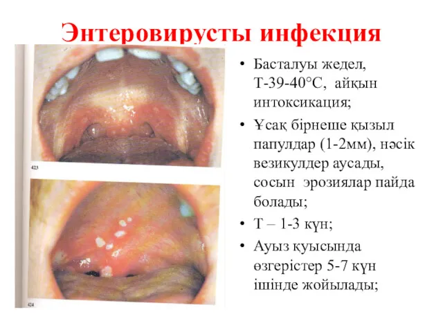 Энтеровирусты инфекция Басталуы жедел, Т-39-40°С, айқын интоксикация; Ұсақ бірнеше қызыл