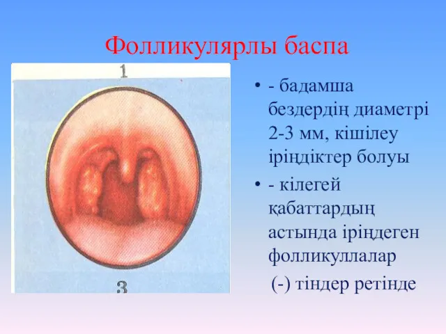 Фолликулярлы баспа - бадамша бездердің диаметрі 2-3 мм, кішілеу іріңдіктер