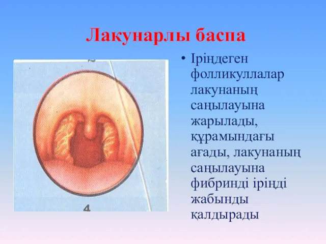 Лакунарлы баспа Іріңдеген фолликуллалар лакунаның саңылауына жарылады, құрамындағы ағады, лакунаның саңылауына фибринді іріңді жабынды қалдырады