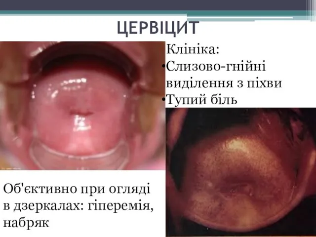 ЦЕРВІЦИТ Клініка: Слизово-гнійні виділення з піхви Тупий біль Об'єктивно при огляді в дзеркалах: гіперемія, набряк