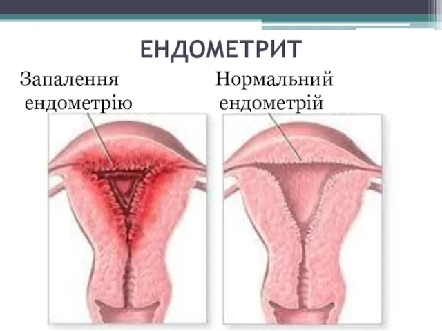 ЕНДОМЕТРИТ Запалення ендометрію Нормальний ендометрій