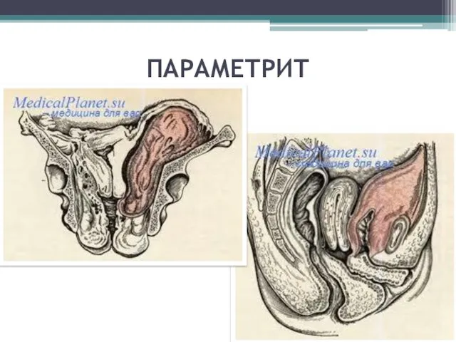 ПАРАМЕТРИТ