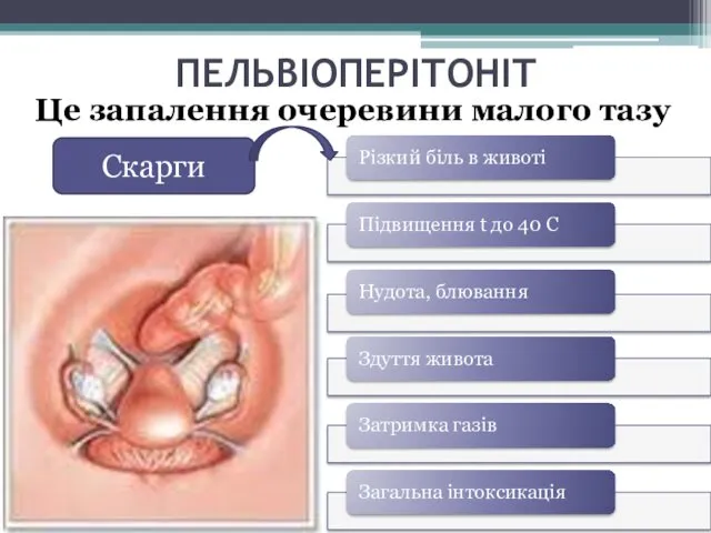 ПЕЛЬВІОПЕРІТОНІТ Це запалення очеревини малого тазу Скарги