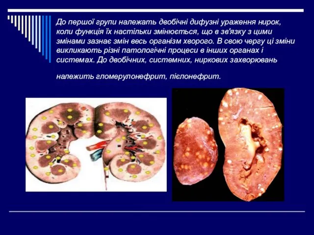 До першої групи належать двобічні дифузні ураження нирок, коли функція