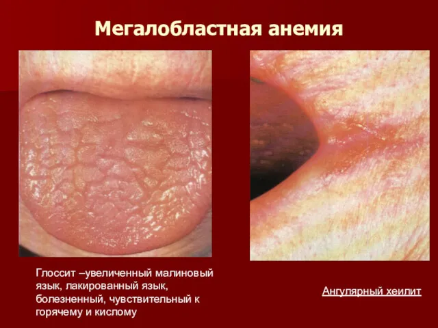 Мегалобластная анемия Глоссит –увеличенный малиновый язык, лакированный язык, болезненный, чувствительный к горячему и кислому Ангулярный хеилит