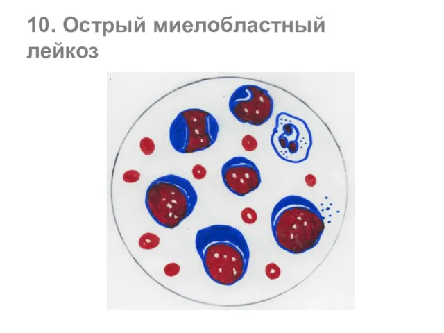 10. Острый миелобластный лейкоз