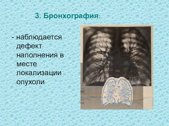 3. Бронхография: - наблюдается дефект наполнения в месте локализации опухоли