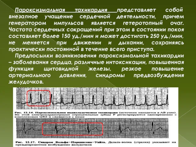 Пароксизмальная тахикардия представляет собой внезапное учащение сердечной деятельности, причем генератором