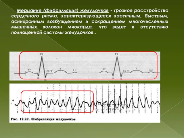 Мерцание (фибрилляция) желудочков - грозное расстройство сердечного ритма, характеризующееся хаотичным,