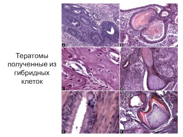 Тератомы полученные из гибридных клеток