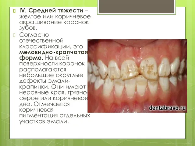 IV. Средней тяжести – желтое или коричневое окрашивание коронок зубов.