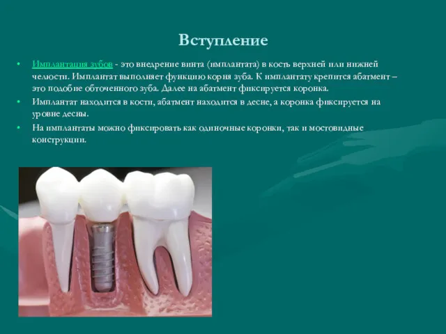 Вступление Имплантация зубов - это внедрение винта (имплантата) в кость