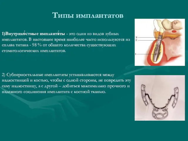 Типы имплантатов 1)Внутрико́стные импланта́ты - это один из видов зубных