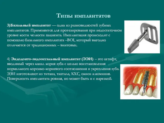 Типы имплантатов 3)Базальный имплантат — одна из разновидностей зубных имплантатов.