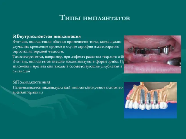 Типы имплантатов 5)Внутрислизистая имплантация Этот вид имплантации обычно применяется тогда,