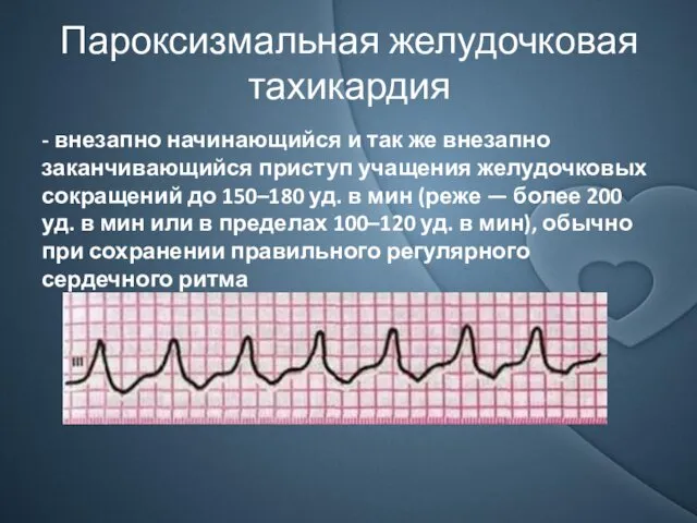 Пароксизмальная желудочковая тахикардия - внезапно начинающийся и так же внезапно