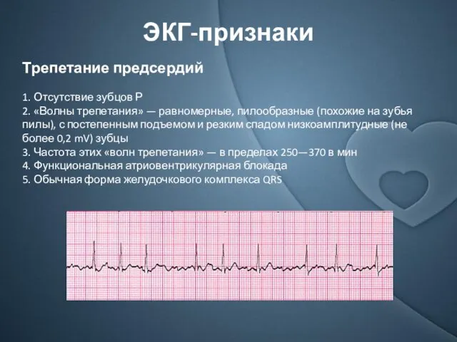 ЭКГ-признаки Трепетание предсердий 1. Отсутствие зубцов Р 2. «Волны трепетания»