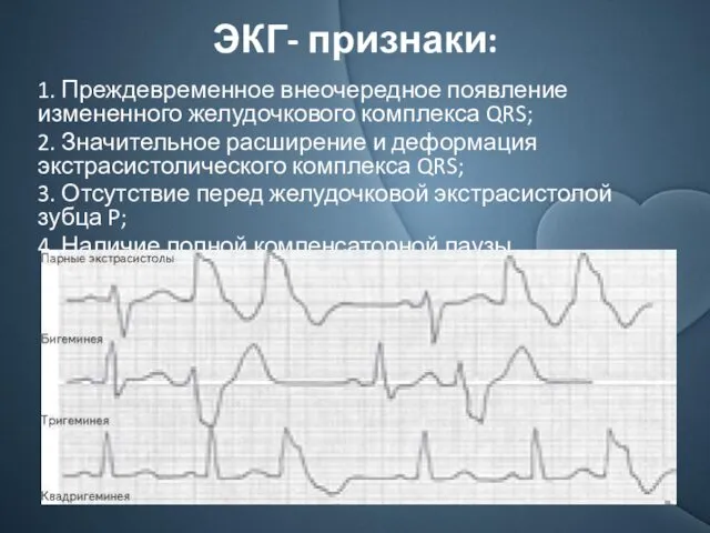 ЭКГ- признаки: 1. Преждевременное внеочередное появление измененного желудочкового комплекса QRS;